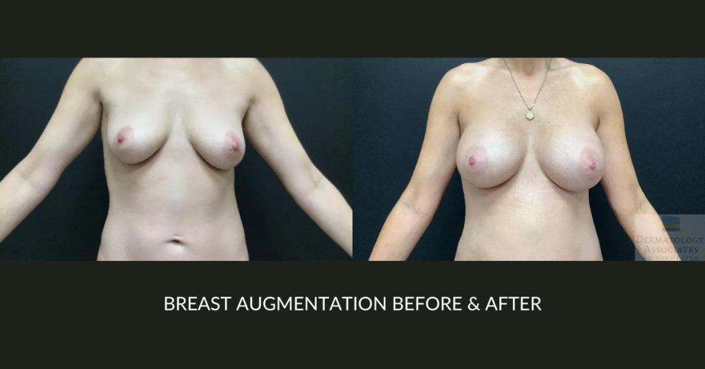 Before and after image of actual patient who received a breast augmentation.