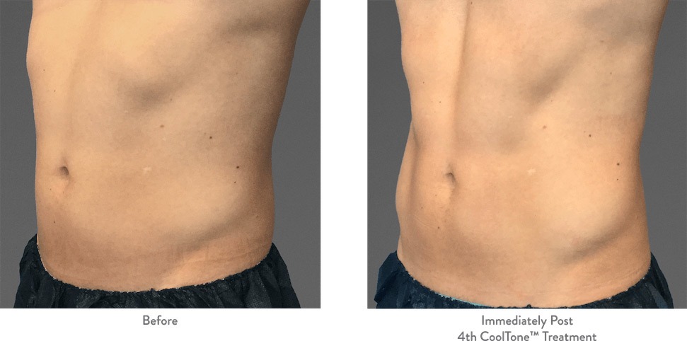 Close-up of male midsection before and after CoolTone, with strong abdominal definition in the after photo.