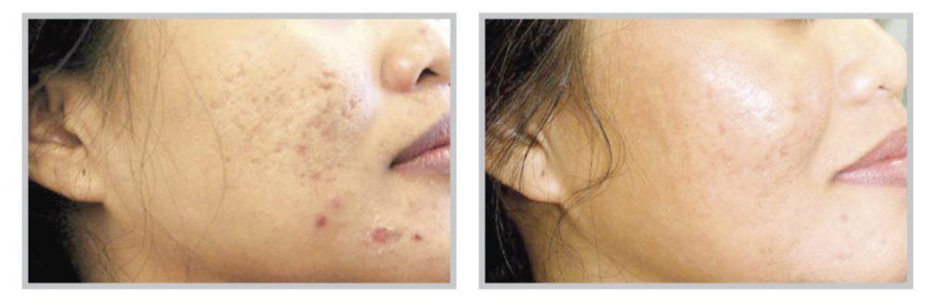 Image of a women's cheek region  before and after laser treatment for acne scars