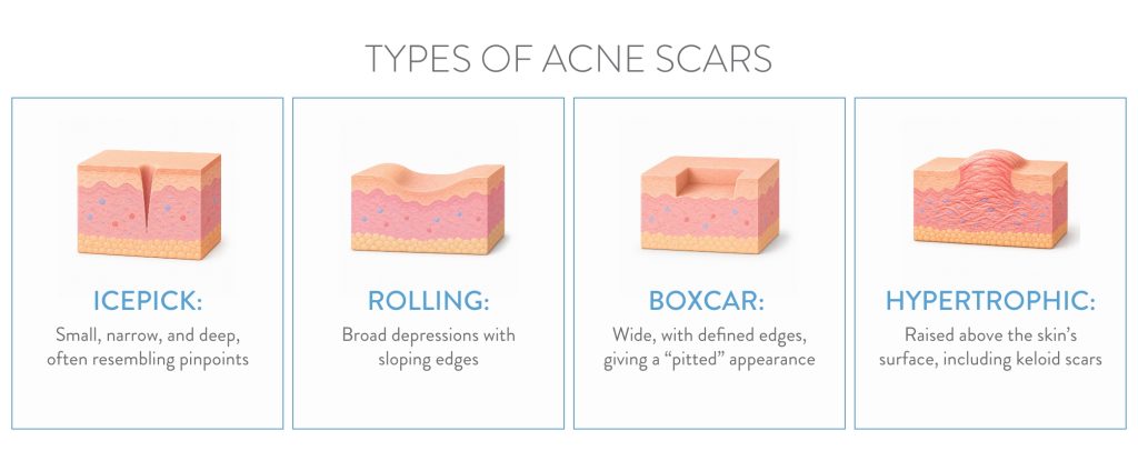 Infographic from Dermatology Associates of Rochester of the different types of acne scars including the icepick, rolling, boxcar, and hypertrophic.